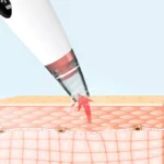 Electric Rechargeable Blackhead Remover - Image 2